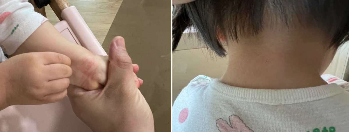 19개월 아기 아토피