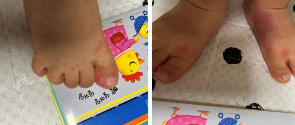 수족구 3일차 증상 수포 및 발진