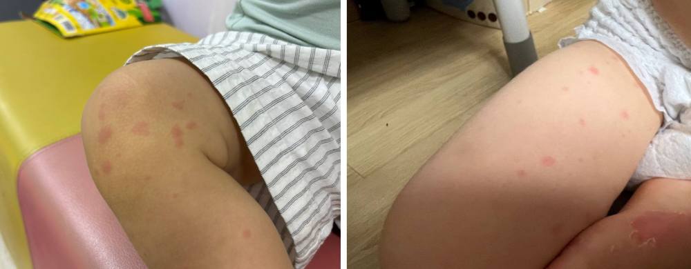 2일차 다형홍반 증상
