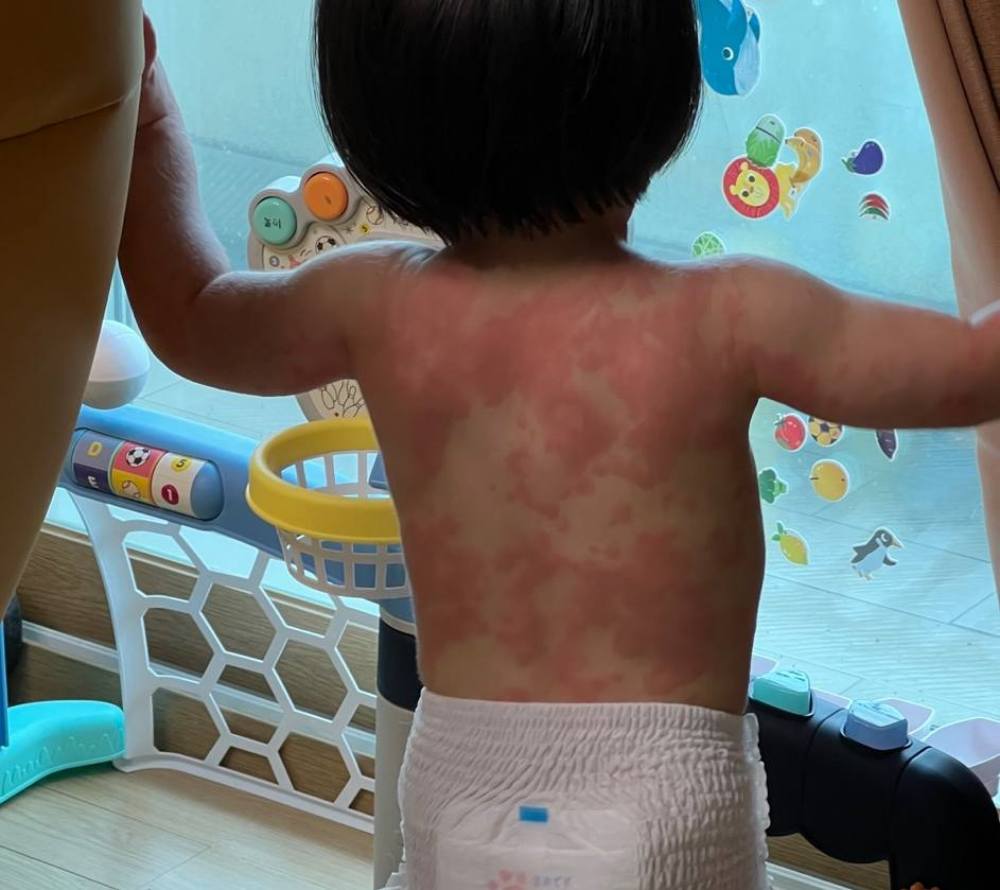 아기 다형홍반